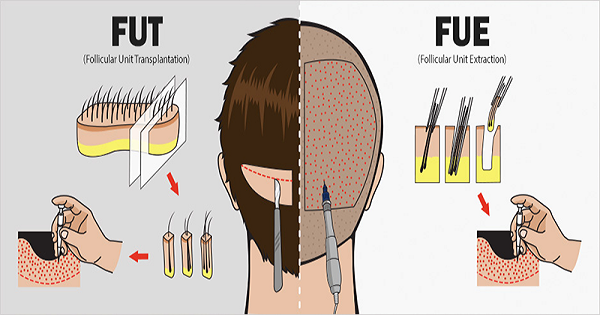 Các phương pháp cấy tóc tự thân phổ biến tại Dr Korea