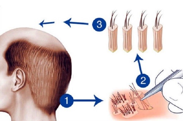 Cấy tóc tự nhân đưa các nang tóc khỏe sang thay thế các nang tóc yếu