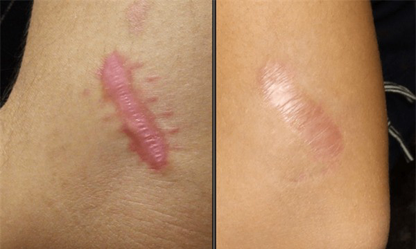 Sẹo lồi là dạng tổn thương thường thấy trên da sau quá trình làm lành vết thương.