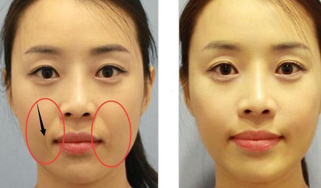 Độn rãnh mũi má giúp làm đầy những vết hằn, từ đó mà cũng trẻ hóa gương mặt