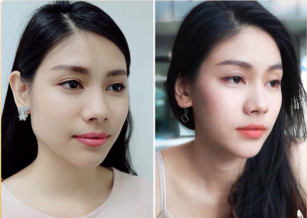 Ảnh khách hàng trước và sau khi thu gọn hàm bằng Botox tại Dr Korea