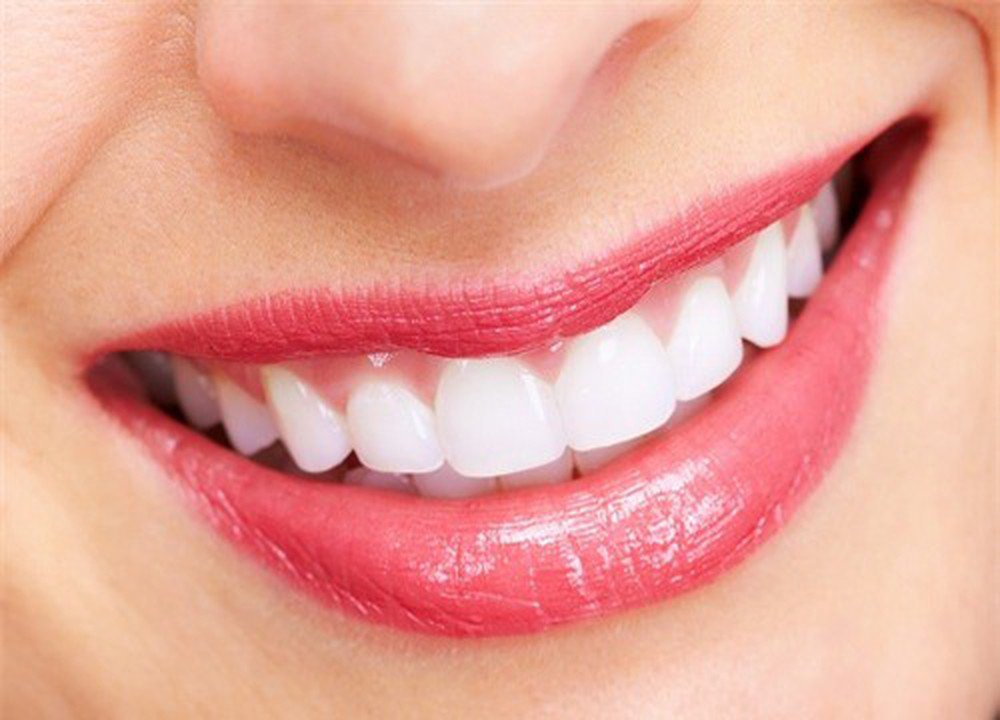 Nụ cười tỏa sáng nhờ phương pháp bọc răng sứ