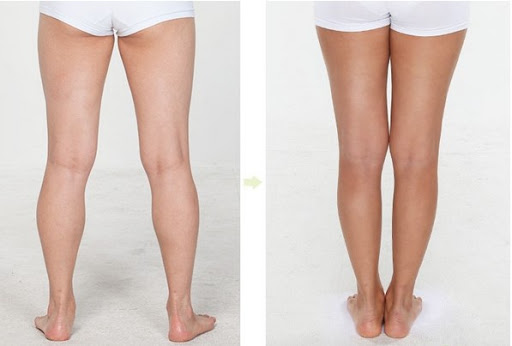 Trước và sau khi thực hiện giảm béo bắp tay bắp chân