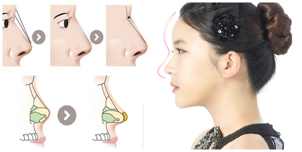 Sửa mũi hỏng giúp khắc phục tình trạng mũi hỏng sau thẩm mỹ