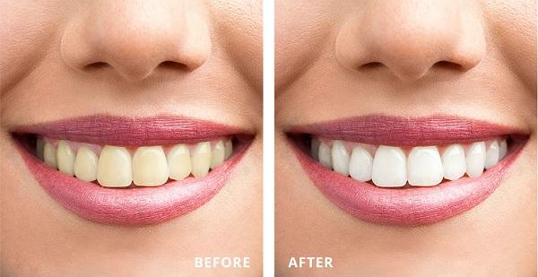 Trước và sau khi thực hiện tẩy trắng răng