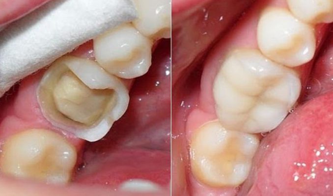 Trước và sau khi thực hiện trám răng