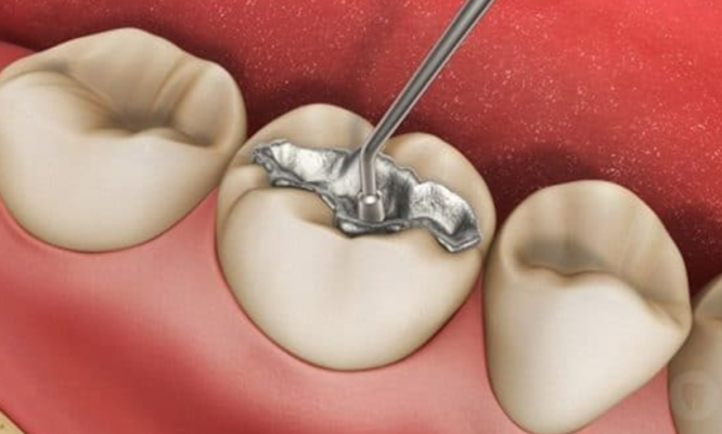 Trám răng giúp khắc phục tình trạng răng khiếm khuyết, sâu răng