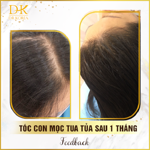 Kết quả của trị liệu cấy tóc chất kích thích mọc tóc Meso Therapy