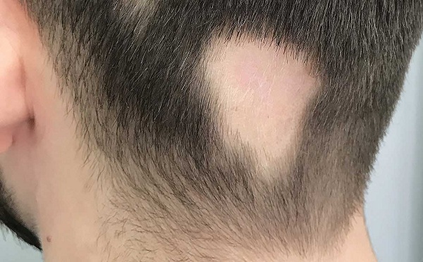 Hình ảnh người mắc bệnh rụng tóc từng mảng với các mảng hói lớn trên da đầu