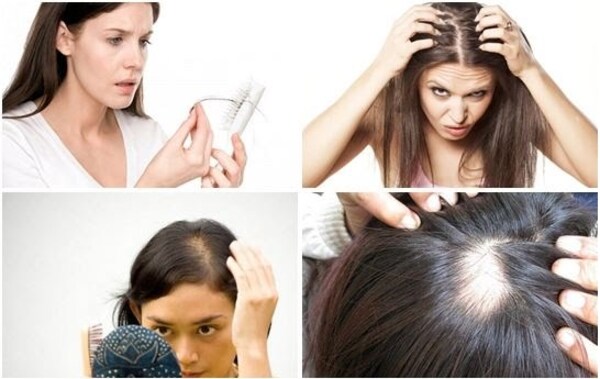 Tóc rụng nhiều, thường xuyên là dấu hiệu tiềm ẩn hói đỉnh đầu nữ