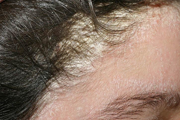 Vảy nến da đầu là tình trạng trên da đầu có vảy màu trắng như vảy cá