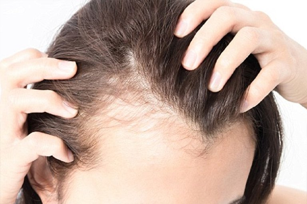 Bị ngứa da đầu và rụng tóc gây hói đầu thì phải làm sao?