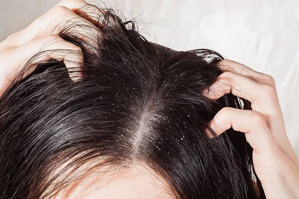 Gàu - nguyên nhân phổ biến gây ngứa da đầu và rụng tóc nhiều