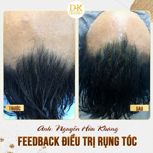 Hình ảnh điều trị rụng tóc của khách hàng tại Dr Korea