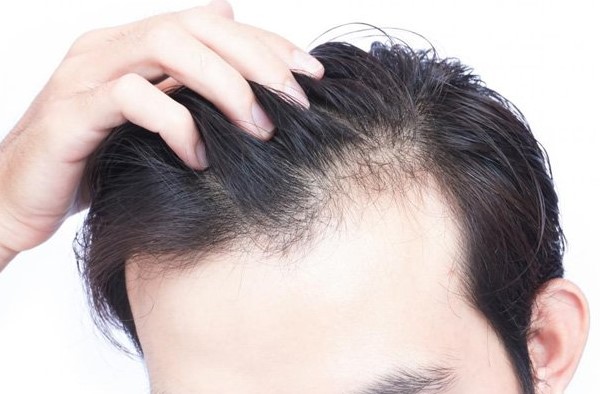 Nam giới cũng có thể rụng tóc do thay đổi nội tiết tố