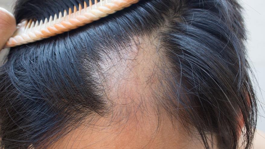 Bạn bị rụng tóc từng vùng do nguyên nhân nào