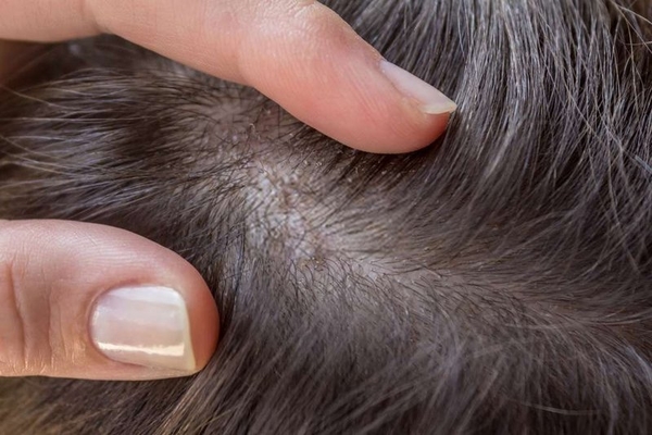 Điều trị viêm nang tóc ở da đầu như thế nào để đạt được hiệu quả tốt nhất