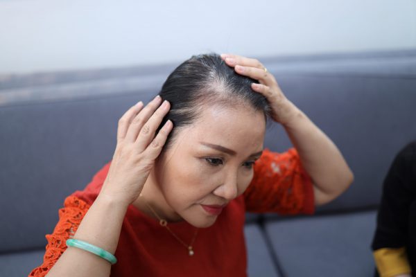 Cô Quỳnh cho biết mình thiếu tự tin khi có mái tóc thưa thớt, mỏng manh.