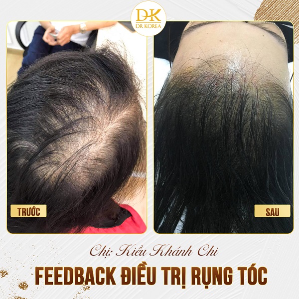 Hình ảnh trước và sau khi cấy tóc tại Dr Korea