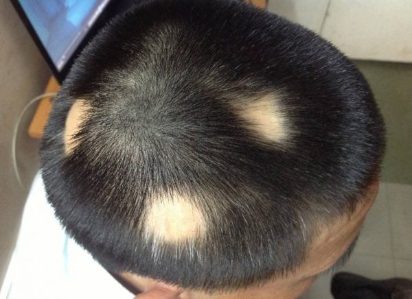 So sánh giá cấy tóc ở Việt Nam so với nước ngoài  caytocquoctecom