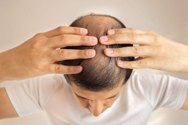 Yếu tố ảnh hưởng đến quá trình mọc tóc trở lại