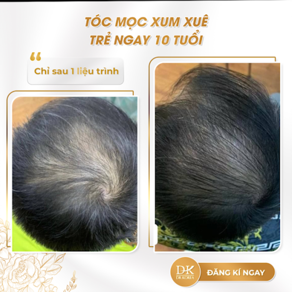 Bệnh Viện Thẩm Mỹ Dr Korea - Địa chỉ điều trị rụng tóc hàng đầu tại Việt Nam