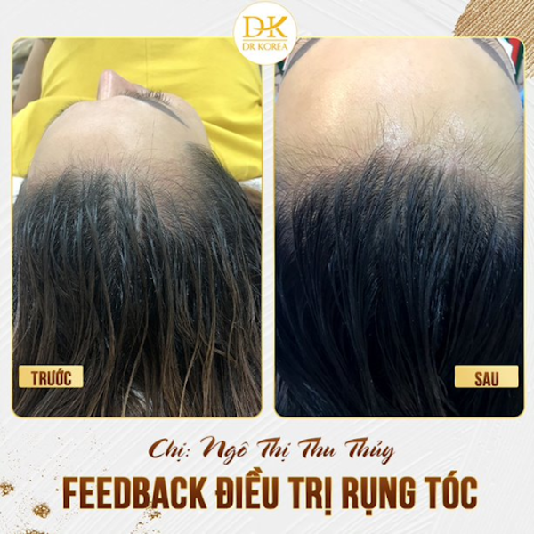 Hình ảnh feedback của khách hàng sau khi cấy tóc tại Dr Korea
