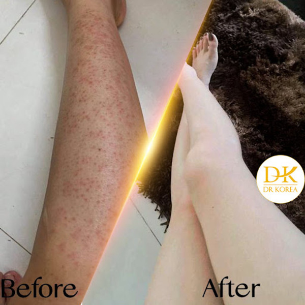 Khách hàng sau khi điều trị viêm nang lông bằng phương pháp Ultra Skin tại Dr Korea