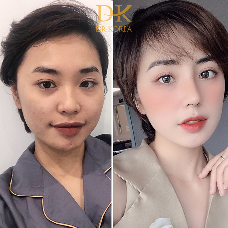 Chị Ngọc Anh (25 tuổi) Tình trạng đầu mũi thô, to cánh mũi rộng. Sau khi nâng mũi Hàn Quốc dáng mũi đã trở nên thon gọn, tự nhiên tôn lên vẻ đẹp của khuôn mặt.