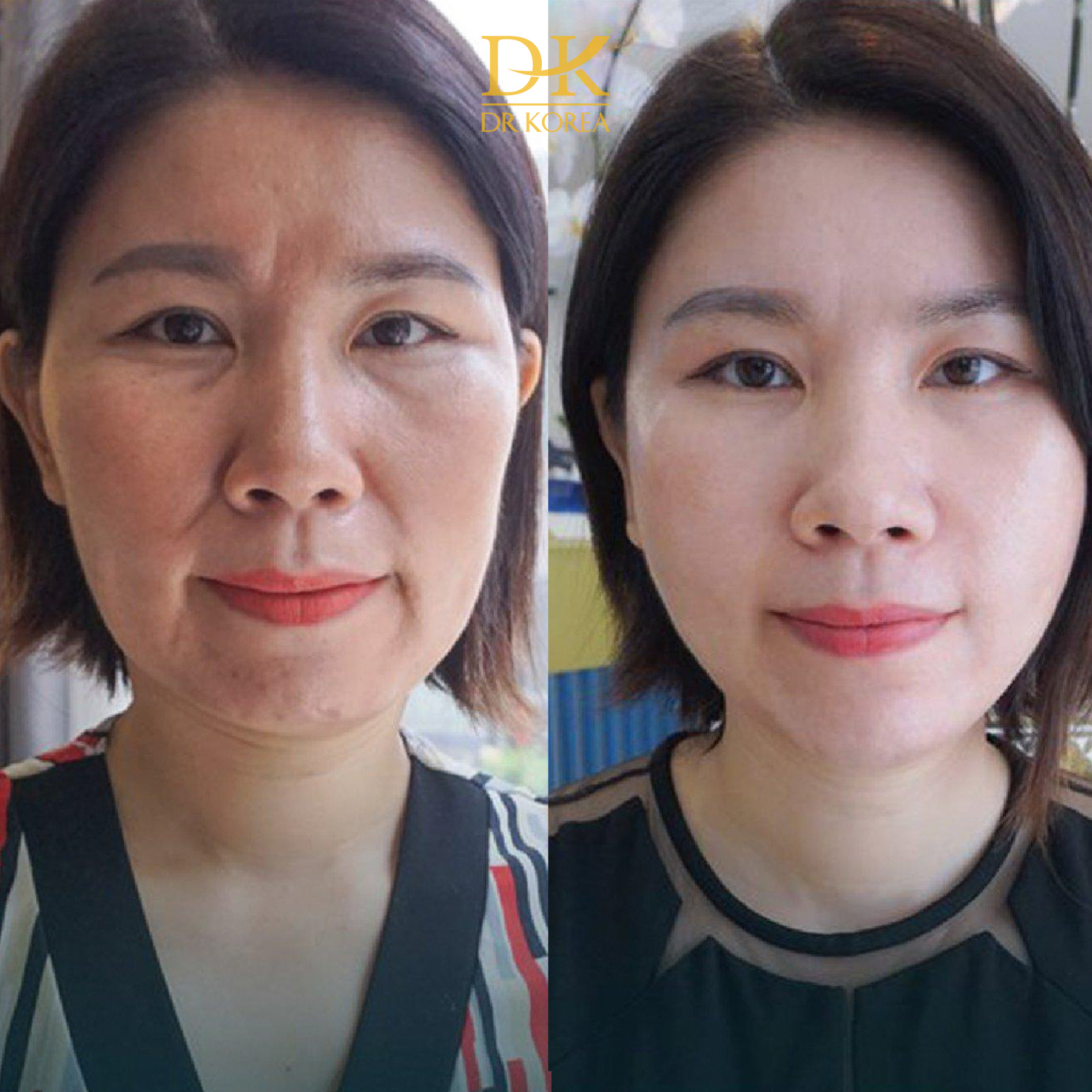Chị Phương Thảo (34 tuổi) da kém tươi sáng và xuất hiện nếp nhăn ở trán, rãnh cười. Sau khi Căng Chỉ Collagen da chị khỏe đẹp hơn, những nếp nhăn đã không còn.