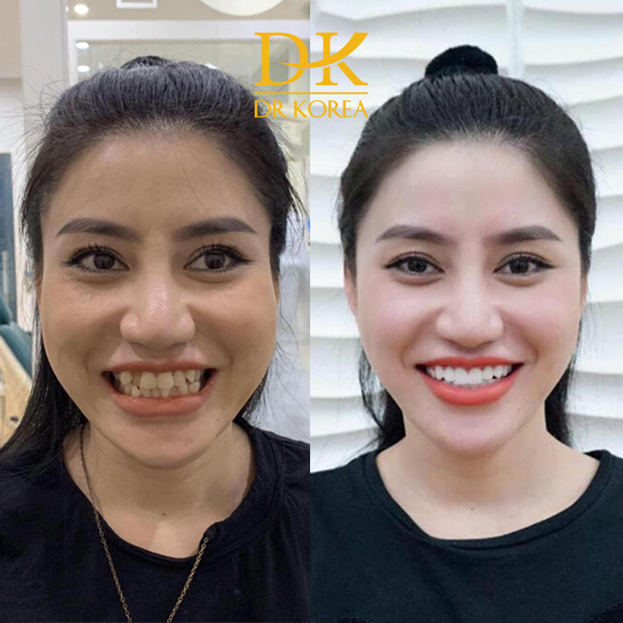 Bạn Trang (26 tuổi) răng bị ố vàng và mọc lệch khi cười không được đẹp. Sau khi Bọc Răng Sứ răng trắng đều và có thể tự tin mỗi khi mỉm cười1