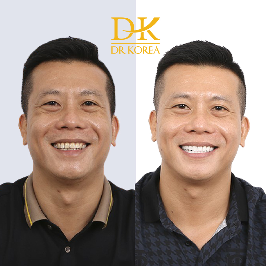 Anh Lê Minh (38 tuổi) Răng đã bị ố vàng khi cười không được thẩm mỹ. Sau khi Dán Răng Sứ anh đã có nụ cười rạng rỡ và phong độ hơn1