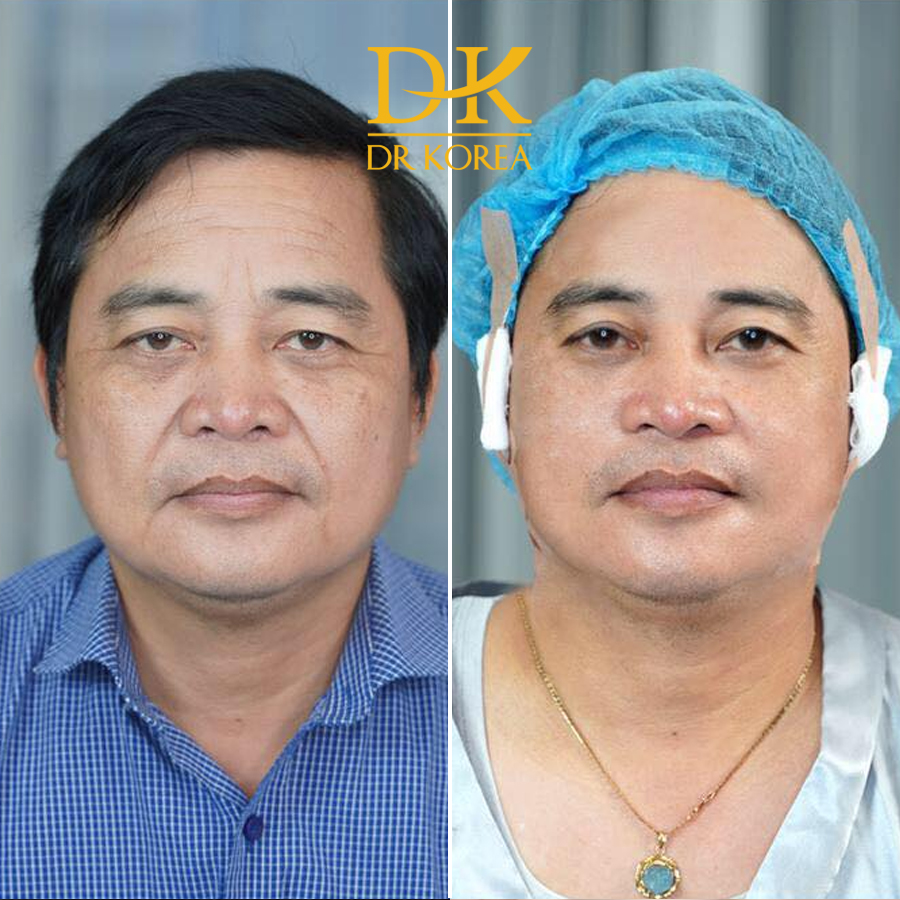 Anh Lê Minh (53 tuổi) xuất hiện nhiều những nếp nhăn trán, khóe mắt và rãnh cười. Sau khi liệu trình Căng Da toàn mặt đã loại bỏ hầu hết các khuyết điểm