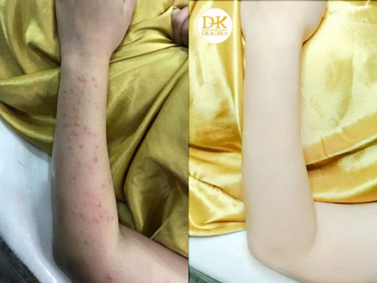 Dr Korea - Địa chỉ điều trị viêm nang lông được nhiều khách hàng lựa chọn
